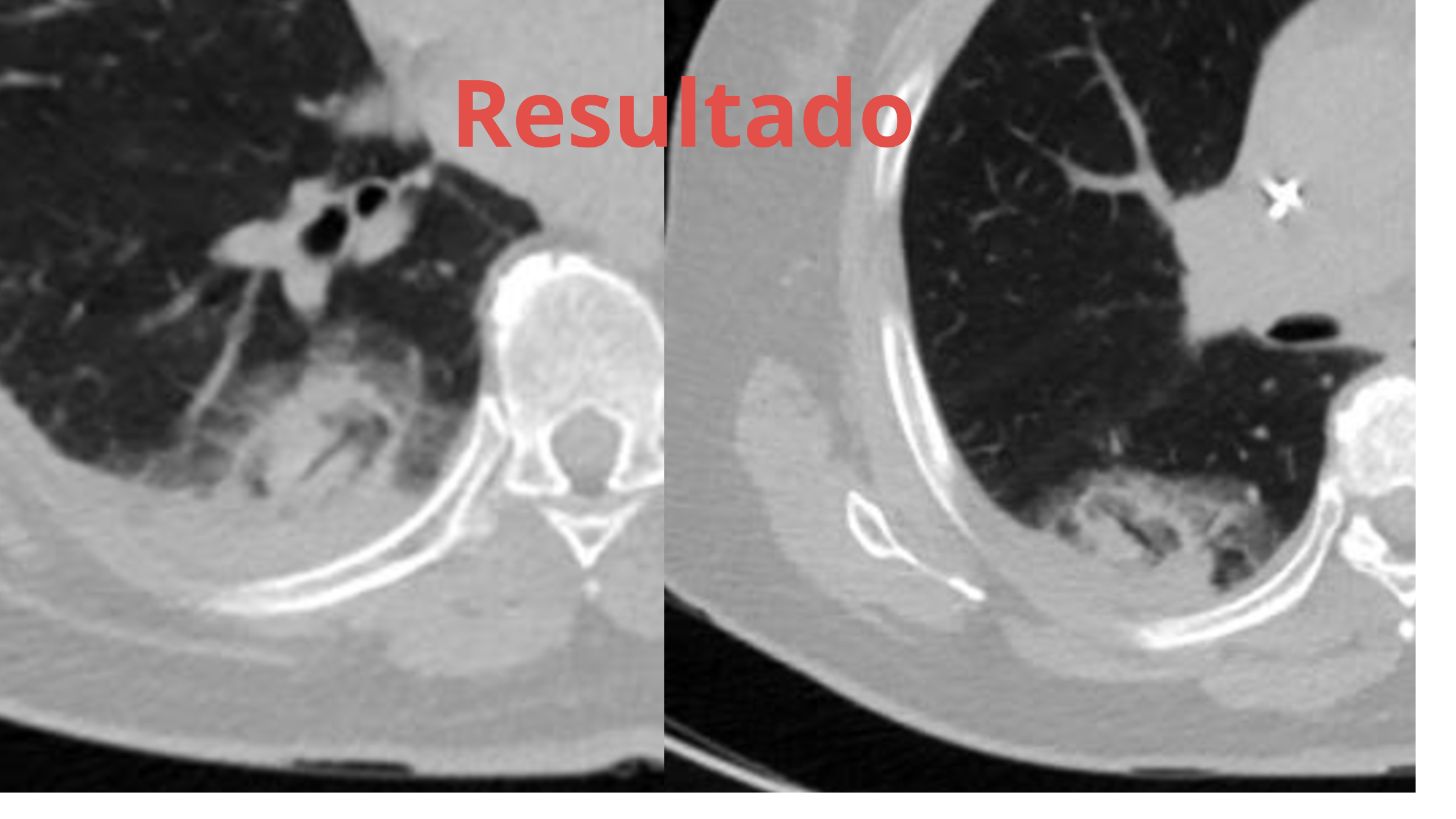 Controle tomográfico com áreas de ablação abrangendo os dois nódulos pulmonares.