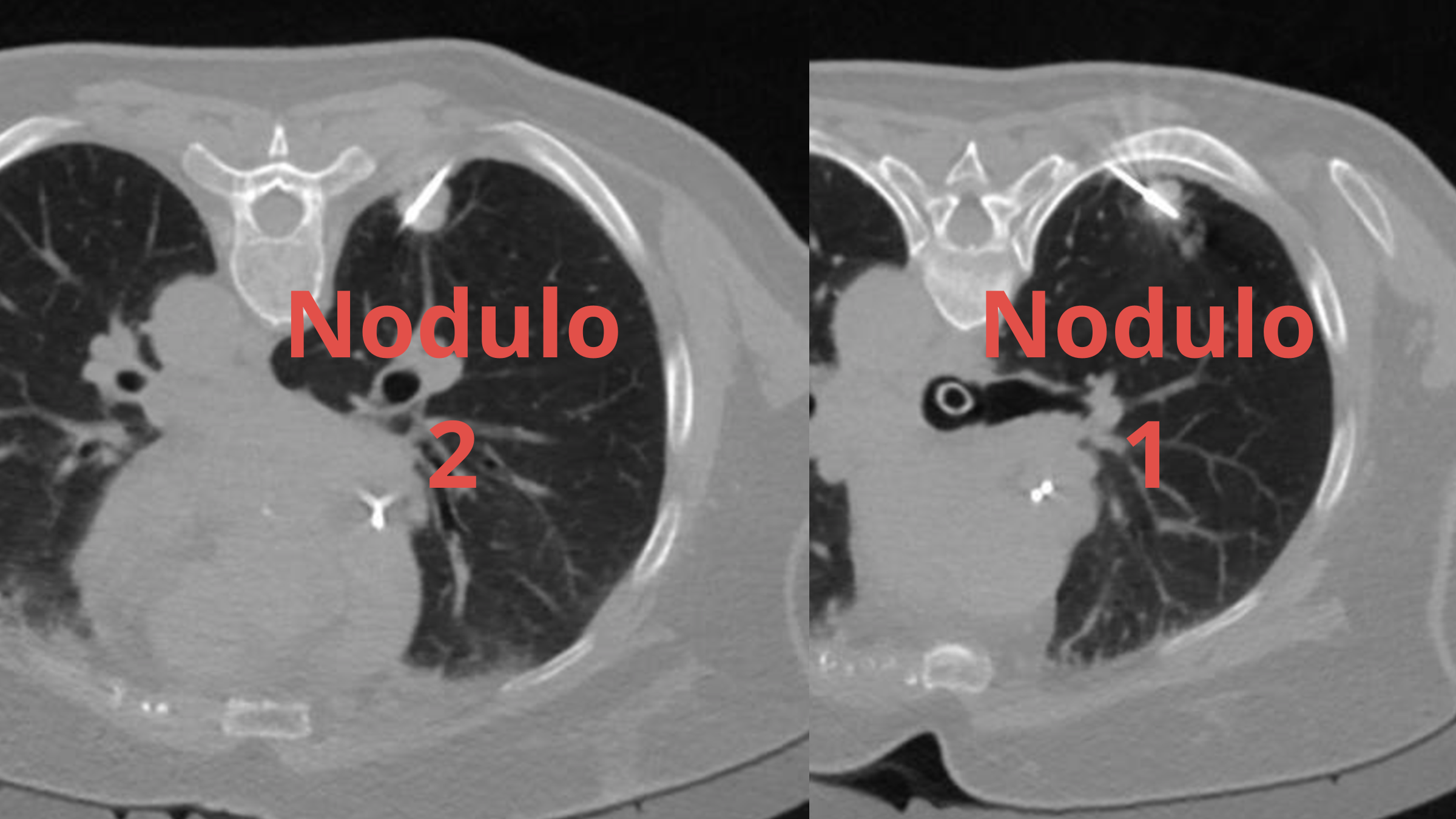 Tomografias com probes de ablação posicionadas nos dois nódulos pulmonares.