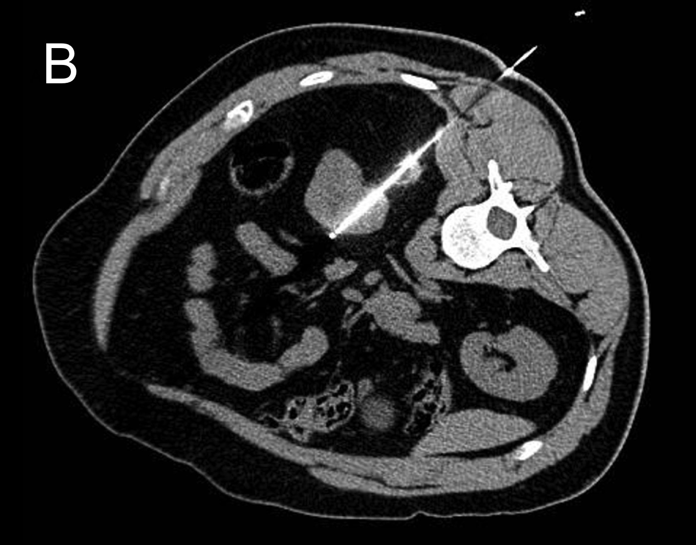 Tomografia durante ablação renal, com aplicador posicionado por punção. Imagem da aula do Dr. João Paulo.