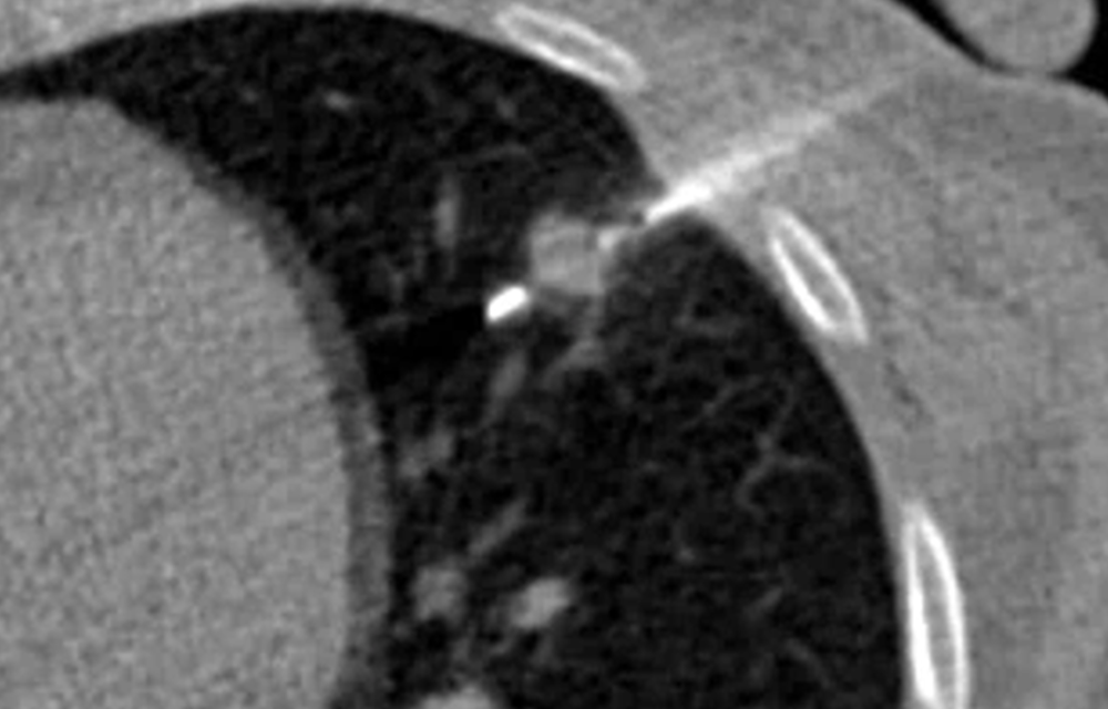 Agulha de biópsia guiada por tomografia posicionada no nódulo pulmonar.