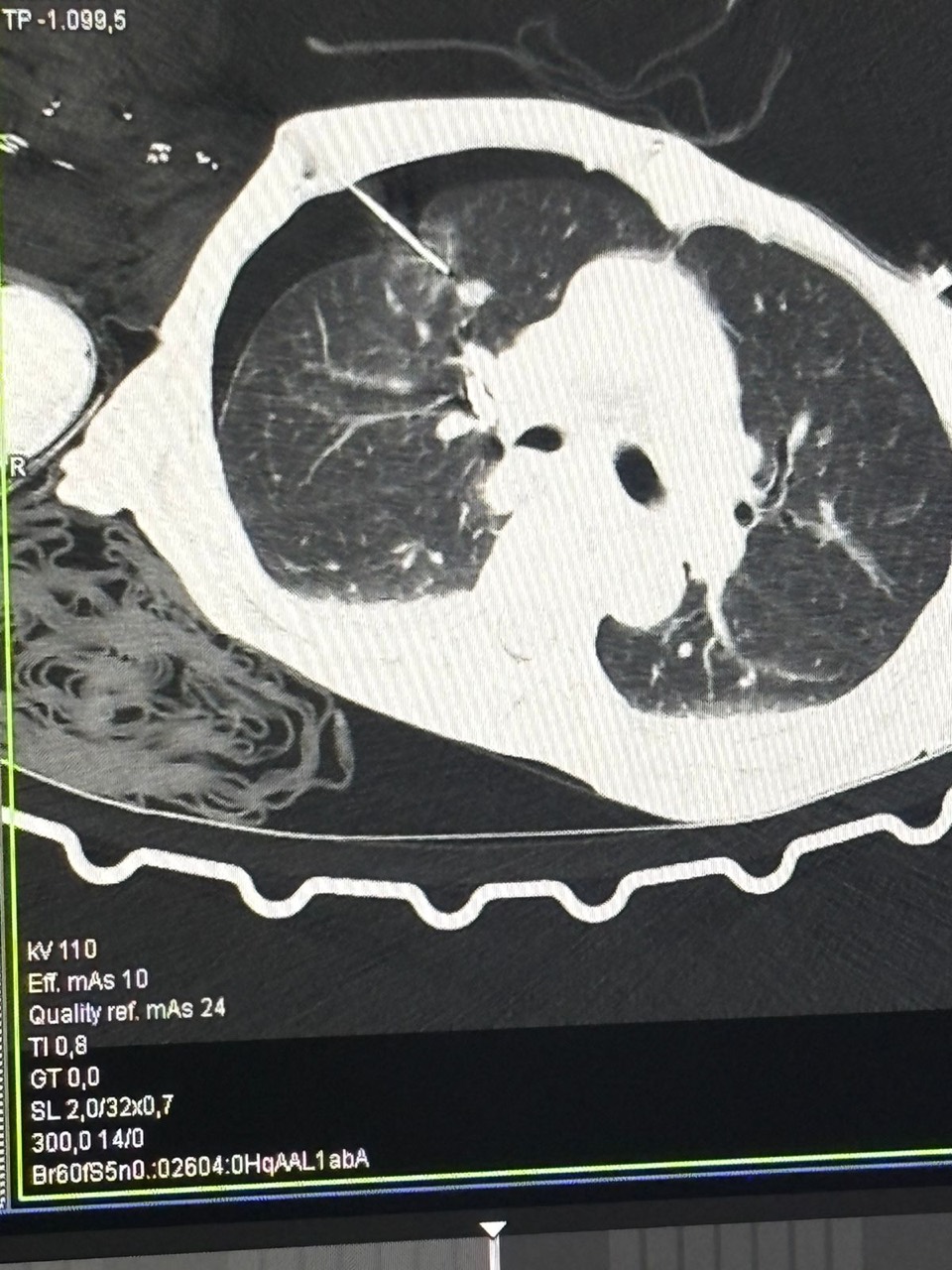 Posicionamento da agulha guiado por tomografia no mesmo caso de nódulo pulmonar de alto risco de sangramento, realizado com protocolo de segurança no CONNECT 2026.