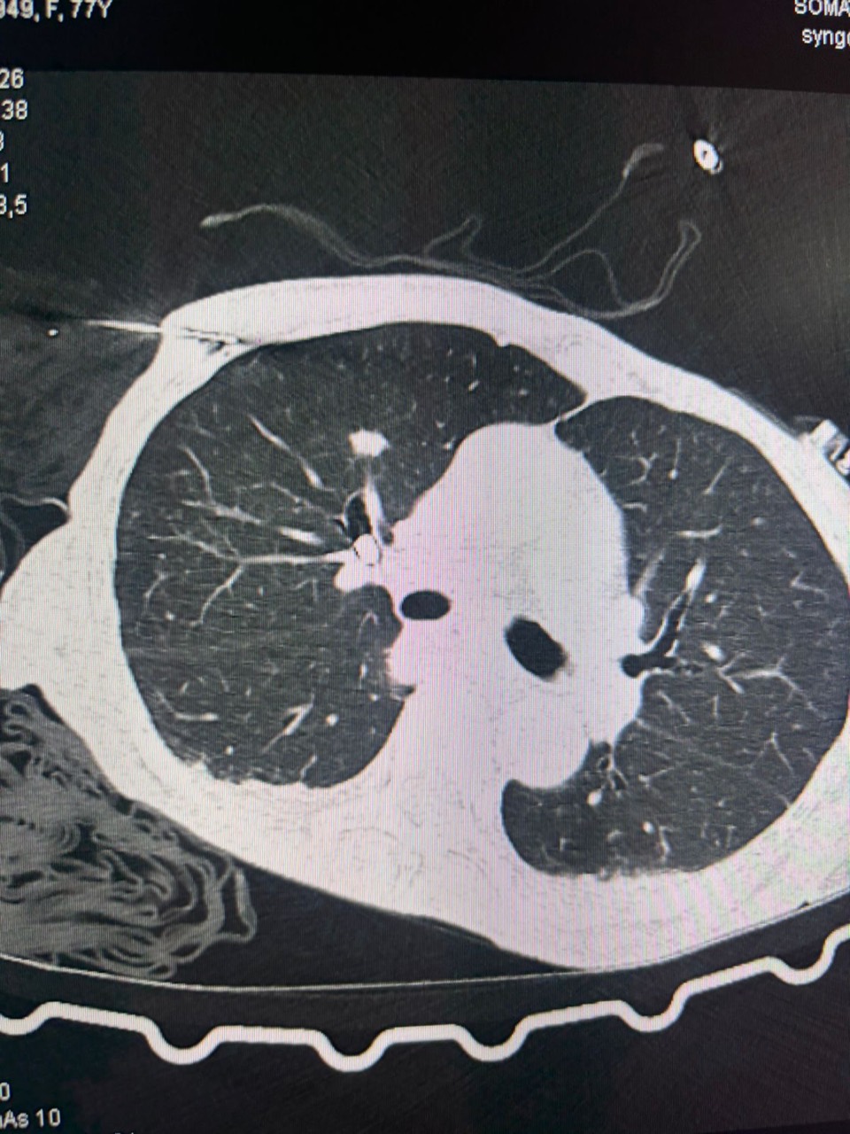 Caso realizado durante o CONNECT 2026, em Manaus: planejamento por tomografia de nódulo pulmonar considerado de alto risco de sangramento, com protocolo de segurança.