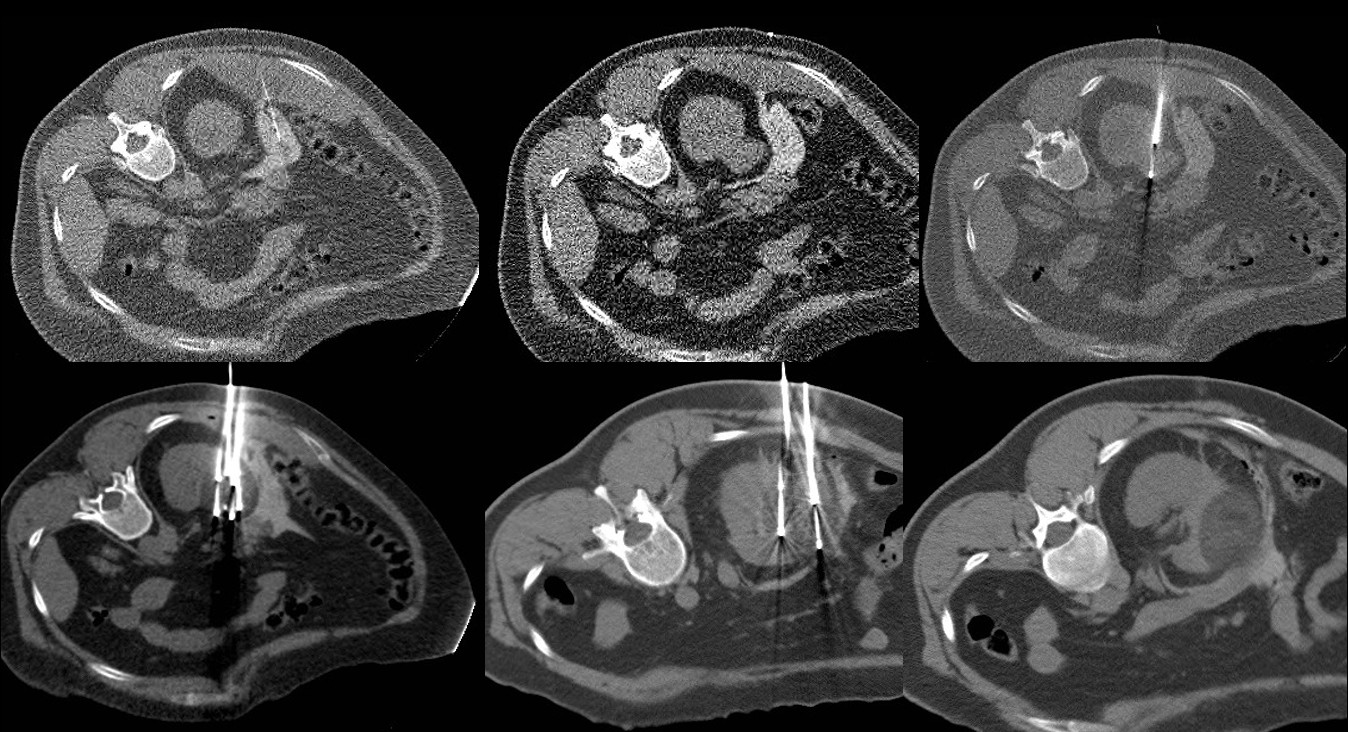 Sequência de tomografias de crioablação renal, com posicionamento de agulhas e acompanhamento da área de tratamento.