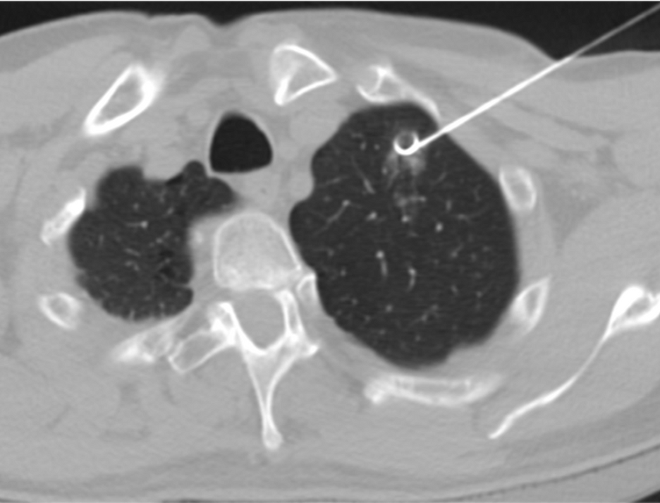 Marcador liberado próximo ao nódulo pulmonar sob orientação tomográfica.