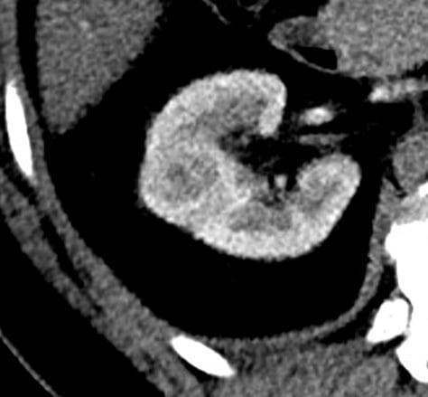 Nódulo renal: o que é e o que fazer com este achado de imagem!