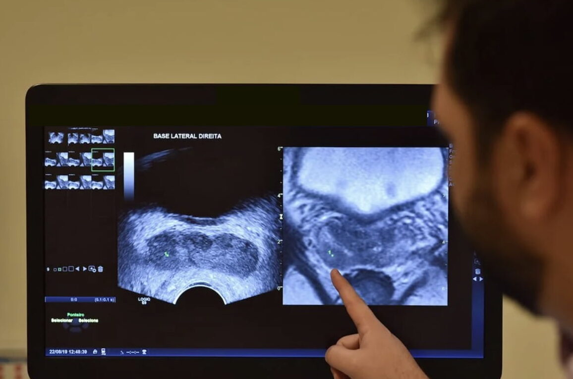 O que é a biópsia de próstata com fusão de imagens em pacientes com Ressonância PI-RADS 4 e PI-RADS 5?