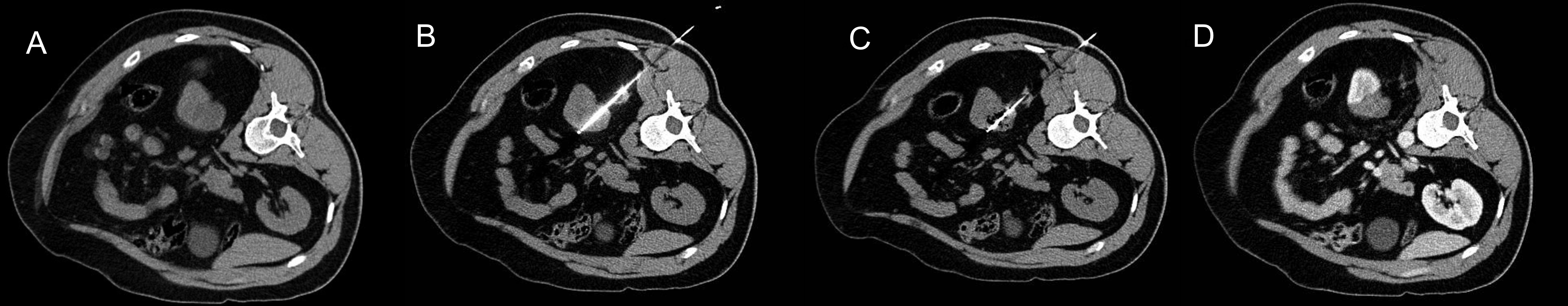 Sequência de quatro imagens de tomografia mostrando etapas de radiofrequência de nódulo renal, apresentada na aula.